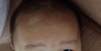 婴儿脸上有小白点的原因有哪些