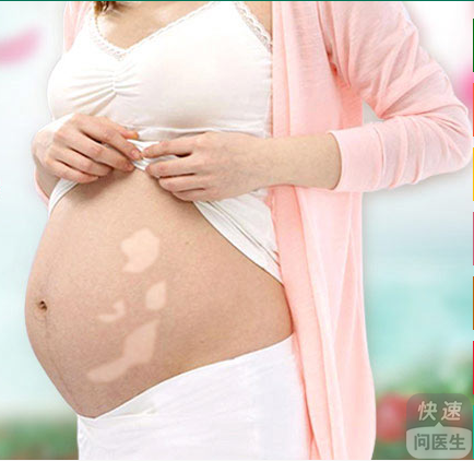 孕妇患有白癜风应该怎么预防